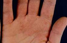 Hand med allergiska utslag